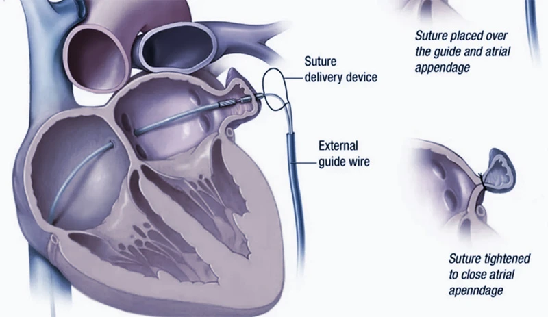 Left Atrial Appendage Closure (LAA)