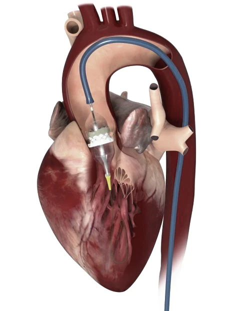 Angioplasty