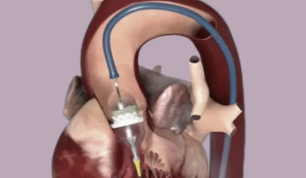 Transcatheter Aortic Valve Replacement (TAVR)