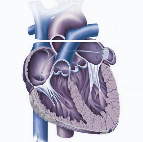 Non-surgical treatment of mitral regurgitation with MitraClip™